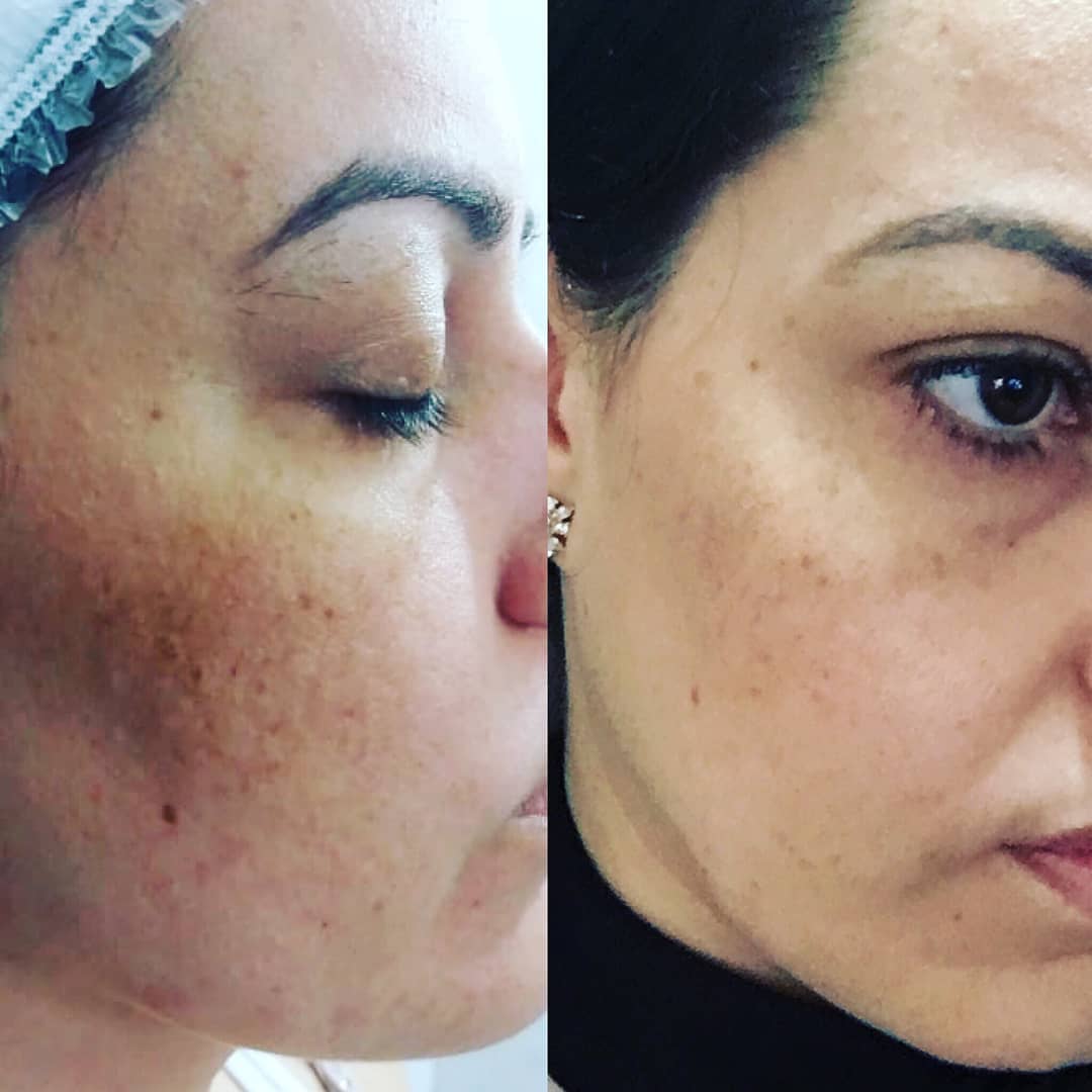 Tratamento de Manchas em Santo André SP | Greicy França Estética