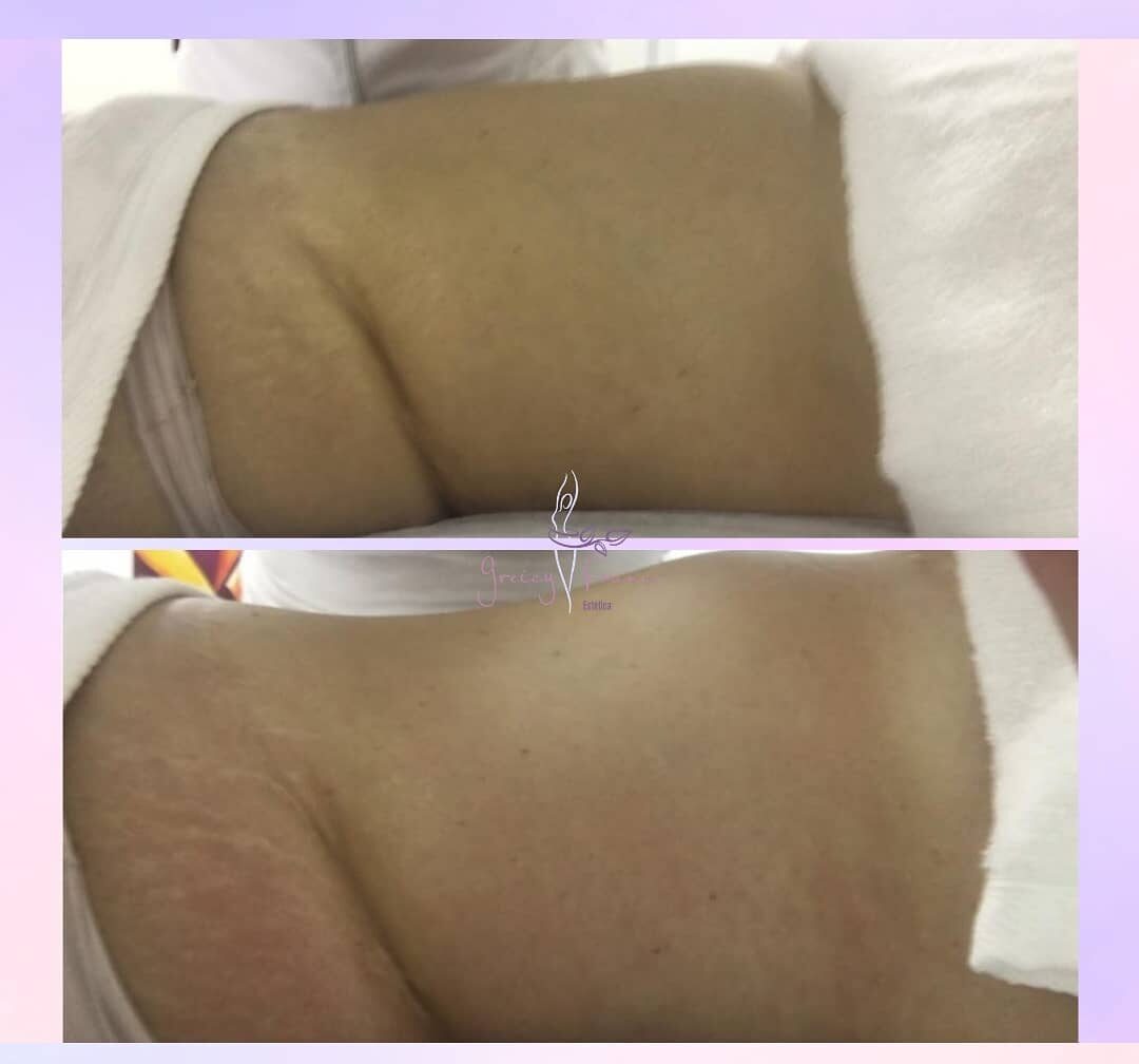 Drenagem Linfática em Santo André SP | Greicy França Estética