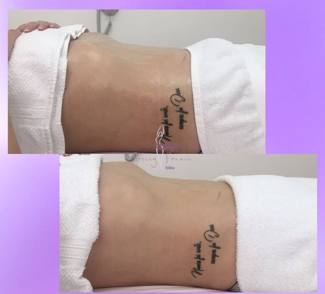 Drenagem Linfática em Santo André SP | Greicy França Estética