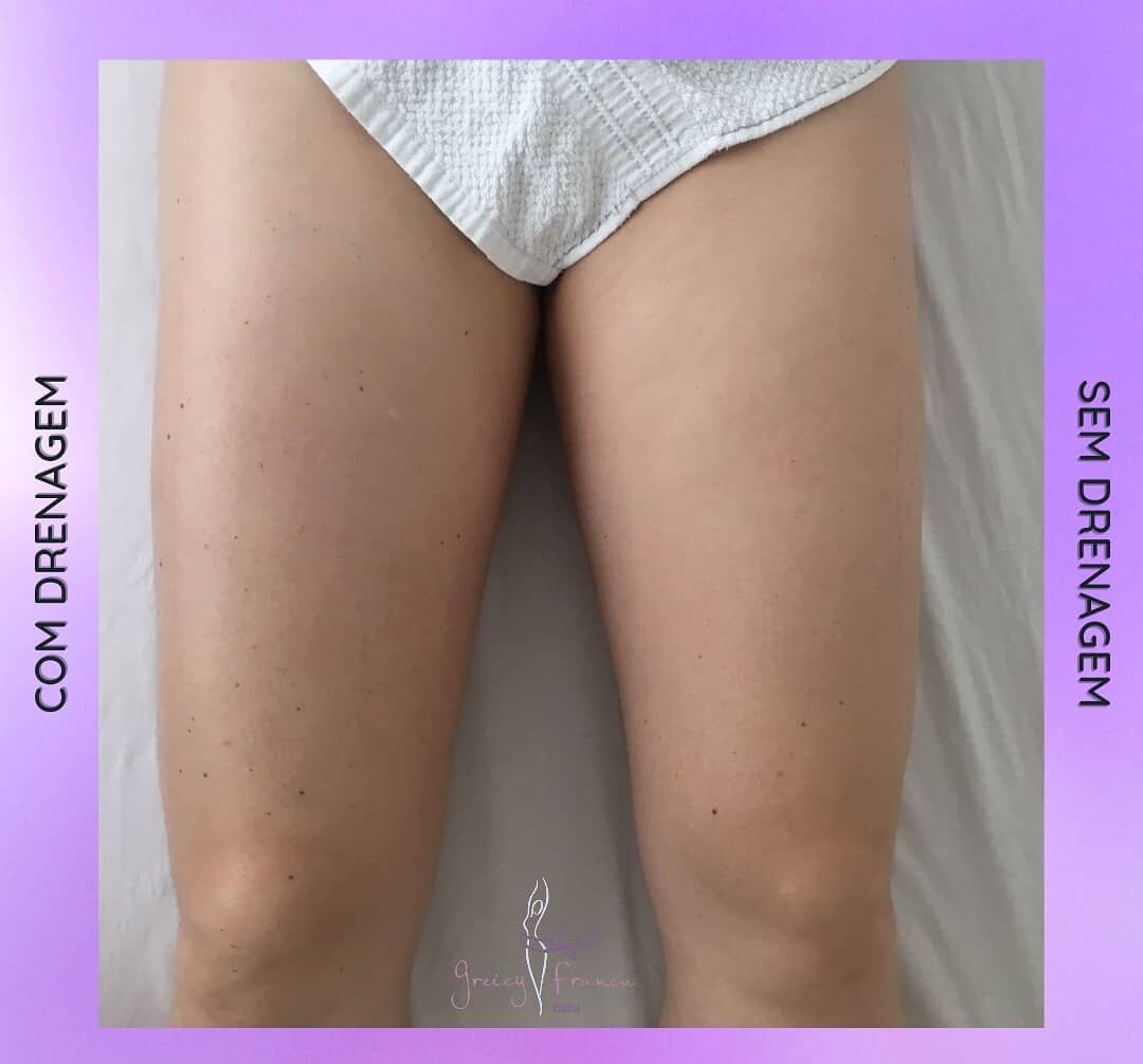 Drenagem Linfática em Santo André SP | Greicy França Estética