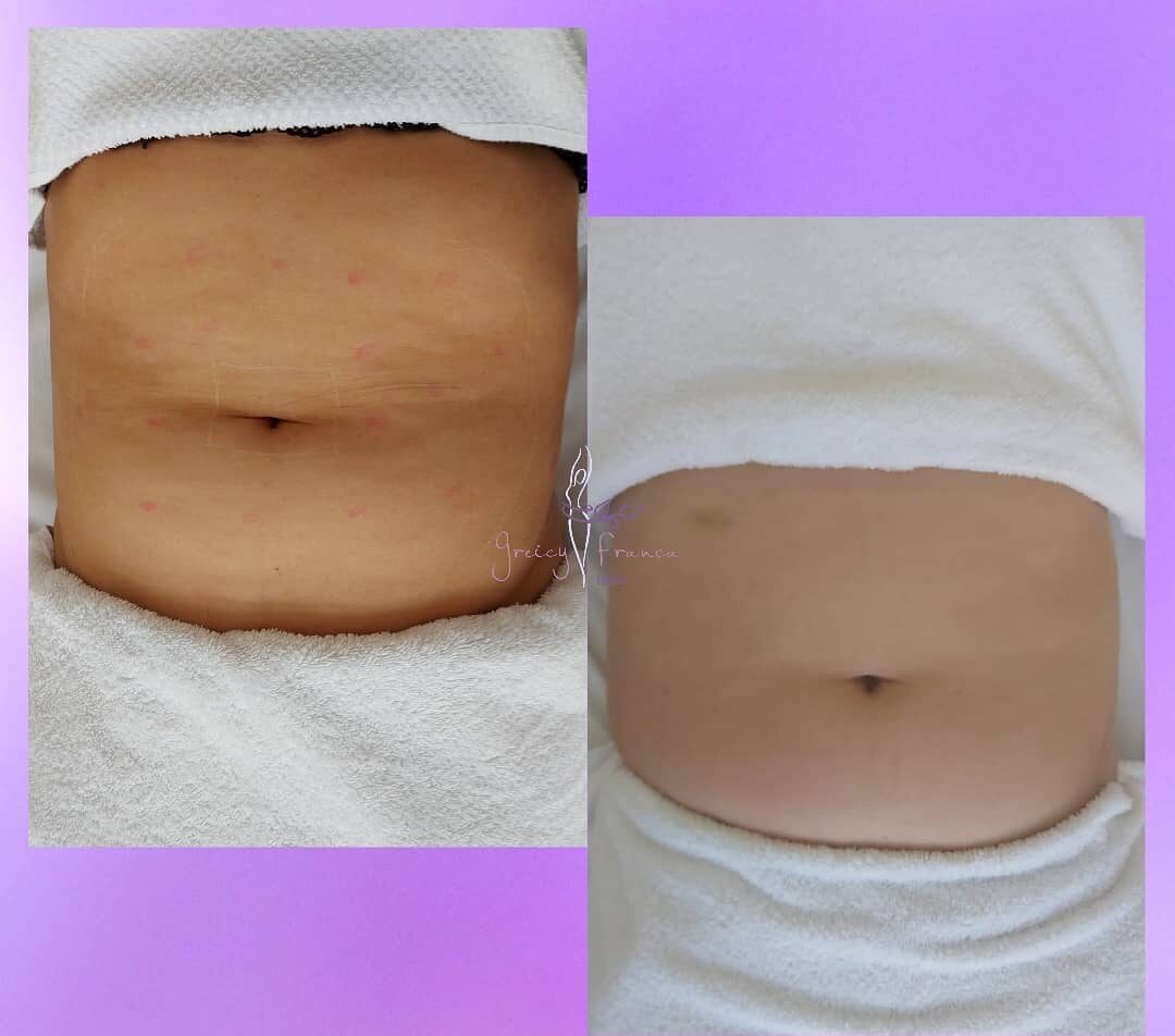 Drenagem Linfática em Santo André SP | Greicy França Estética