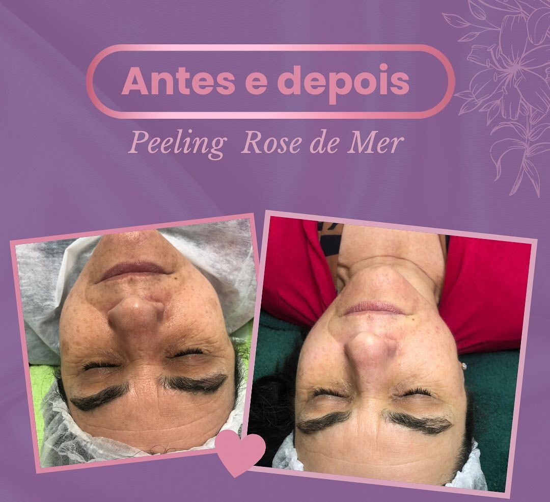 Peeling Facial em Santo André‑SP | Greicy França Estética