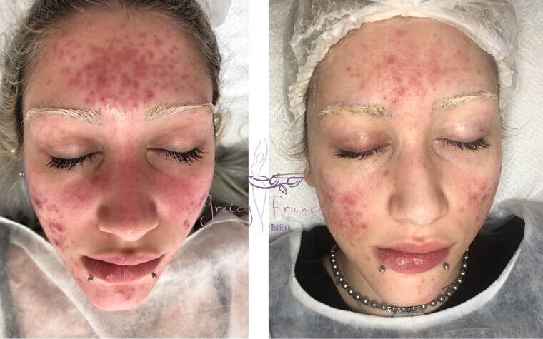 Tratamento de Acne em Santo André SP | Greicy França Estética