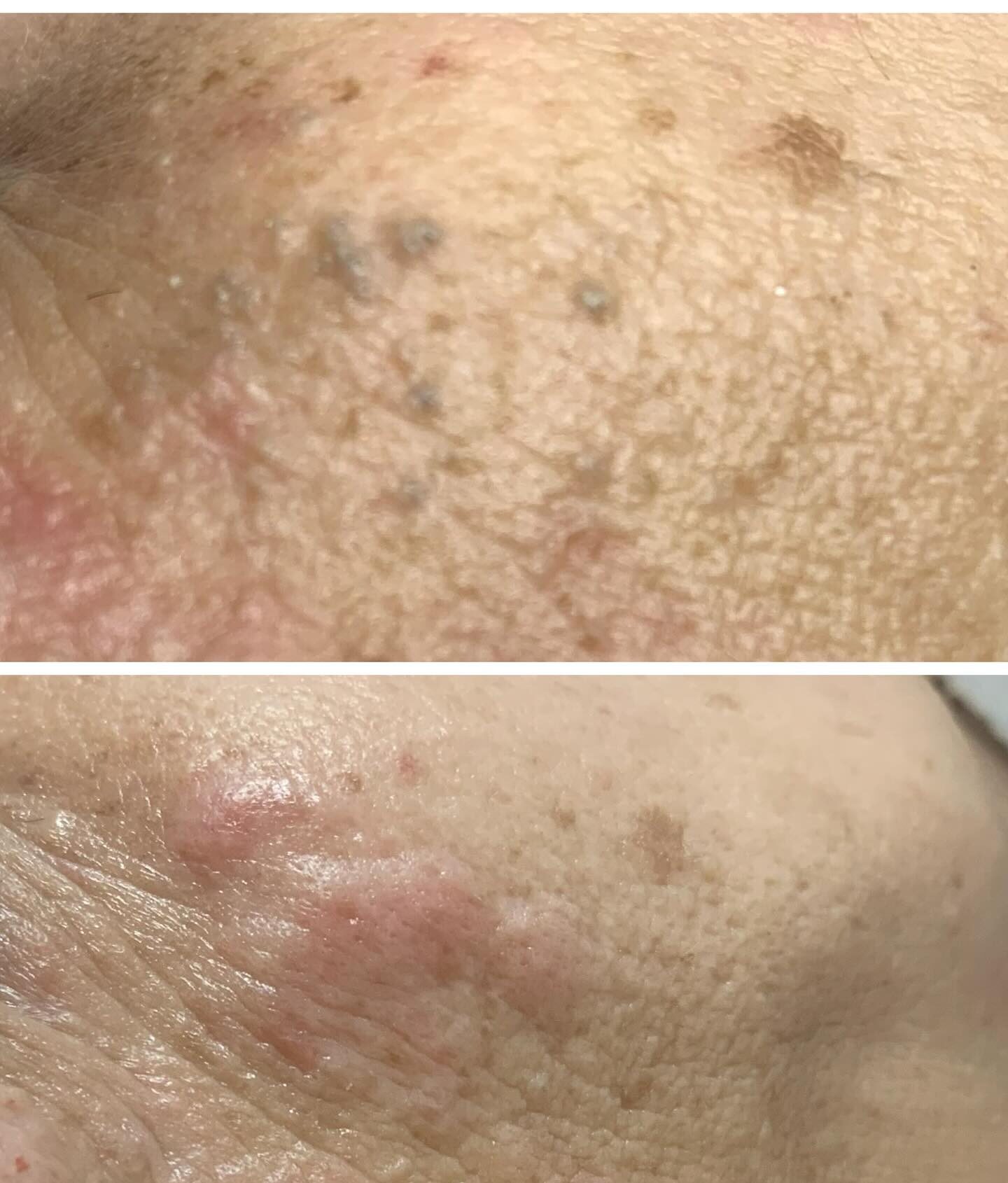 Limpeza de Pele em Santo André‑SP | Greicy França Estética